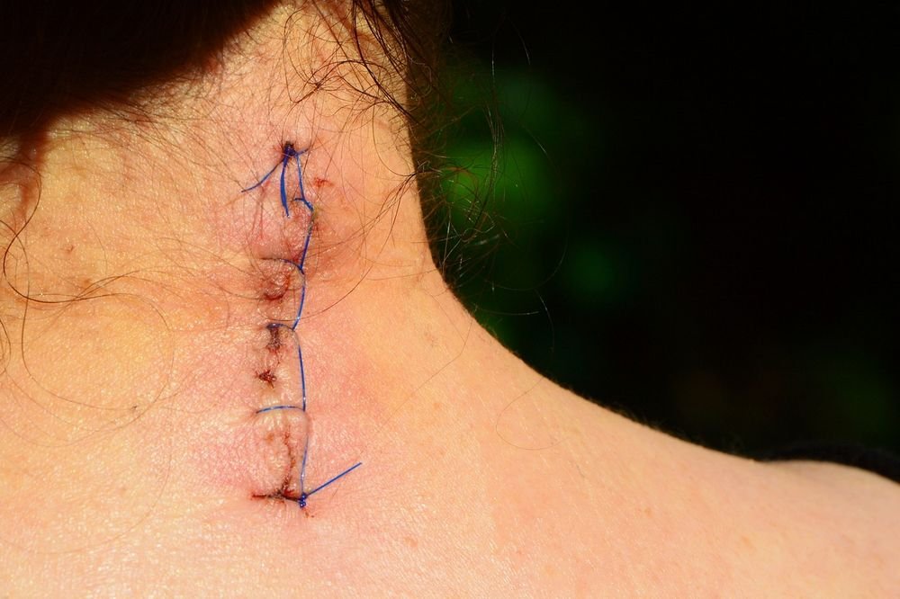 surgical wound healing